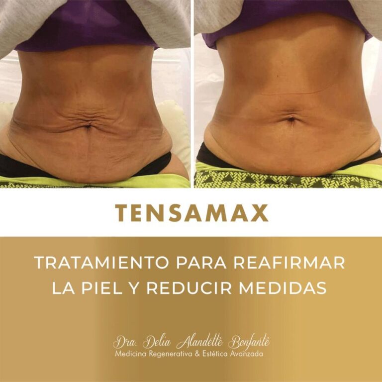 Tratamiento de Flacidez Abdominal con Maximus Tripollar en WAM Center